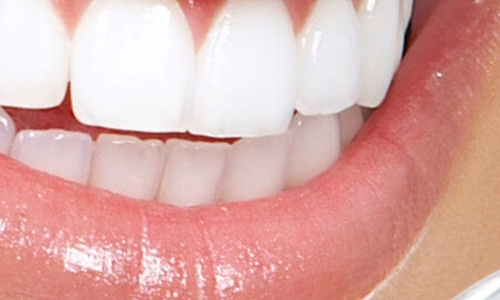 Востановление зубов - виниры