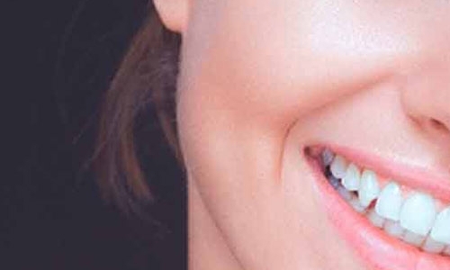 Реставрация зубов с помощью вениров