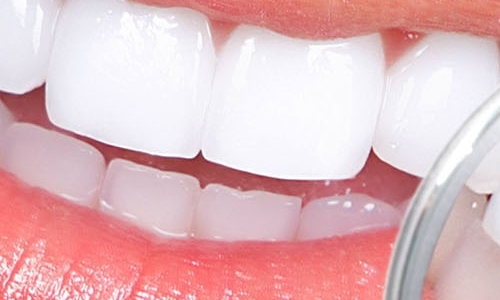 Что делать после отбеливания зубов?